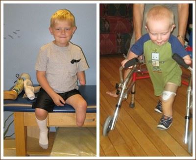 Congenital Limb Defects